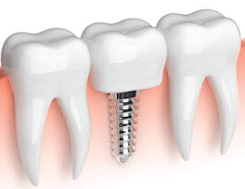 Dental Implant Dentists in Tempe